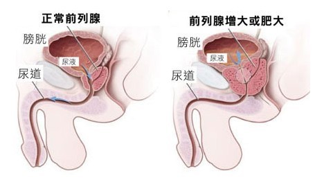 前列腺肥大