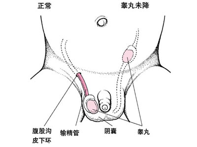 隐睾