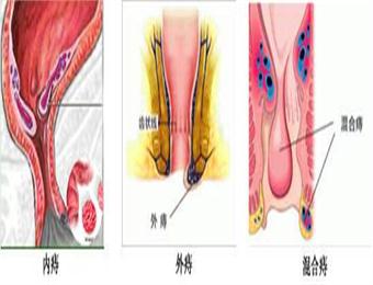 <b>[博爱.健康]“痔”养千日，除在一时</b>