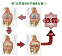 <b>如何预防老年性类风湿性关节炎的发生?</b>