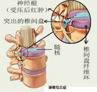 <b>后颈椎骨头突出的原因</b>