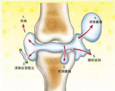 <b>滑膜炎怎么治疗</b>