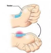 <b>经常玩手机？很多人用这一个动作查出腱鞘炎</b>