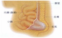 <b>疝气莫信小广告，手术治疗最靠谱</b>