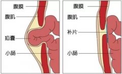 <b>疝气：到底要不要治？！</b>