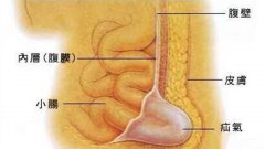 <b>手术——疝气最好的治疗方法</b>