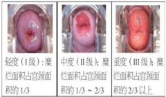 <b>宫颈炎的表现有哪些</b>